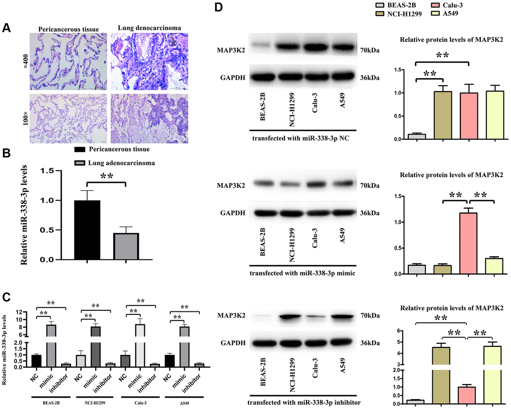 The relationship of miR-338-3p with MAP3K2 in human specimens. (A) Human lung adenocarcinoma and pericancerous tissue were identified by HE staining. (B) The statistical decreased expression of miR-338-3p in adenocarcinoma than pericancerous. **P C) The relative miR-338-3p levels in 4 cell lines after transfected with miR-338-3p NC, mimic, inhibitor. **P D) miR-338-3p mimic decreased the MAP3K2 protein levels, and miR-338-3p inhibitor increased the MAP3K2 protein levels in human adenocarcinoma cell lines: NCI-H1299 and A549 cells but not Calu-3 cells. **P 