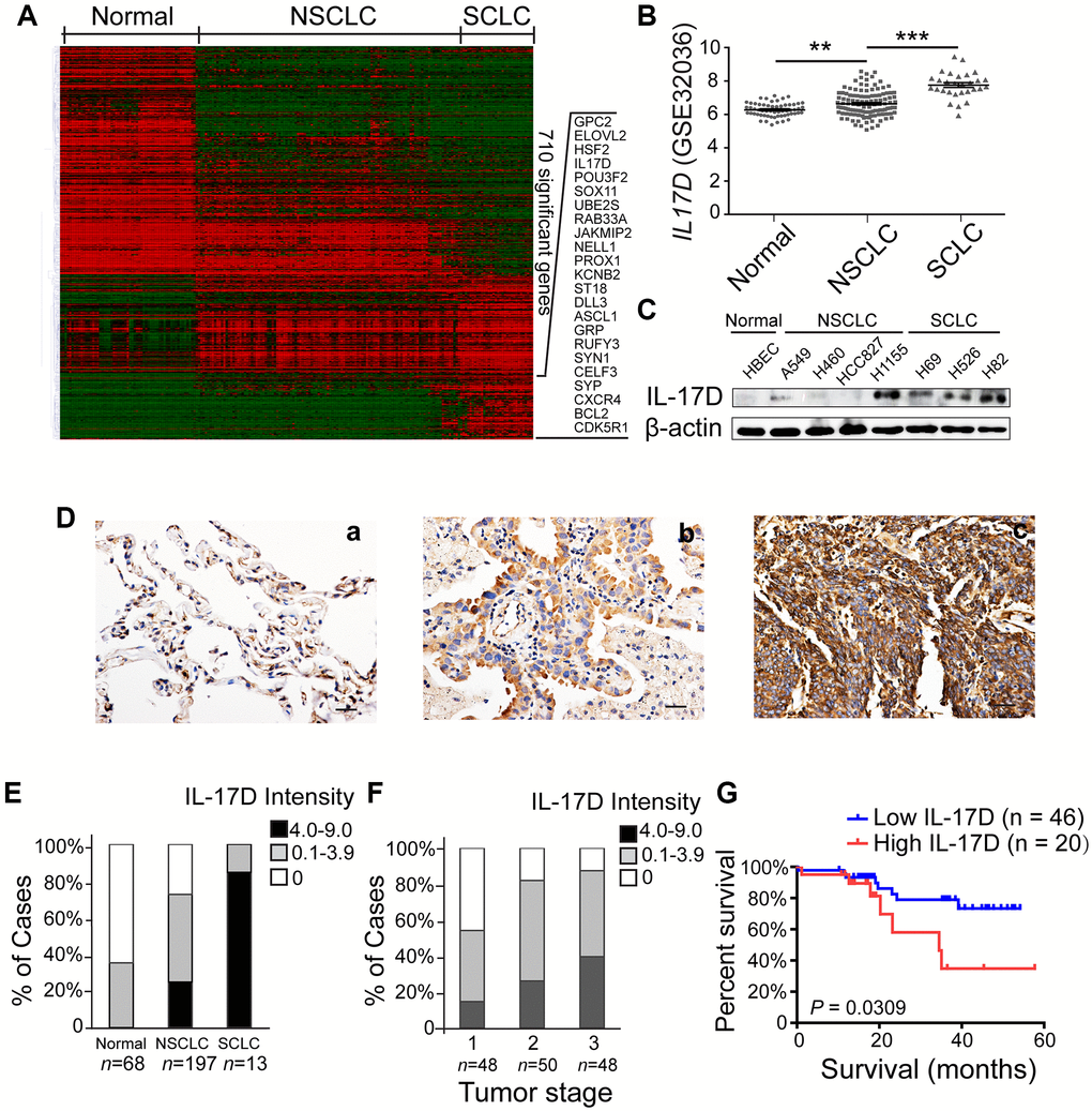 Interleukin (IL)-17D is highly expressed in lung cancer cell lines and tissues and correlates with poor prognosis in human lung cancer. (A) Heatmap of 856 differentially expressed transcripts (710 genes) among normal airway epithelial cell lines (Normal, n = 59), non-small cell lung cancer cell lines (NSCLC, n = 118), and small cell lung cancer cell lines (SCLC, n = 29). (B) RNA-seq data (GSE32036) of IL-17D gene expression of normal airway epithelial cells (n = 59) and NSCLC (n = 118) and SCLC (n = 29) cell lines (value = quantile-normalized and log2-transformed signal). **P ***P C) Immunoblotting was performed to examine the expression level of IL-17D in normal, NSCLC, and SCLC cells. (D) Representative images of immunostaining with anti-IL-17D antibody in tissue sections of human lung tumor adjacent tissue (a), NSCLC tissue (b) and SCLC tissue (c). Scale bars are 20 μm. (E) The frequency of cases with no (0), low (0.1–3.9), or high (4.0–9.0) IL-17D staining stratified by immunohistochemically-defined lung cancer subtype. (F) The frequency of cases with no (0), low (0.1–3.9), or high (4.0–9.0) IL-17D staining stratified by tumor stage. (G) Kaplan-Meier survival rates for 66 subjects with lung cancer disease with low (staining scores n = 46, blue line) versus high (staining scores ≥ 2, n = 20, red line) IL-17D expression were compared. Median survivals were undefined months (low IL-17D) versus 34.52 months (high IL-17D; P = 0.0309).