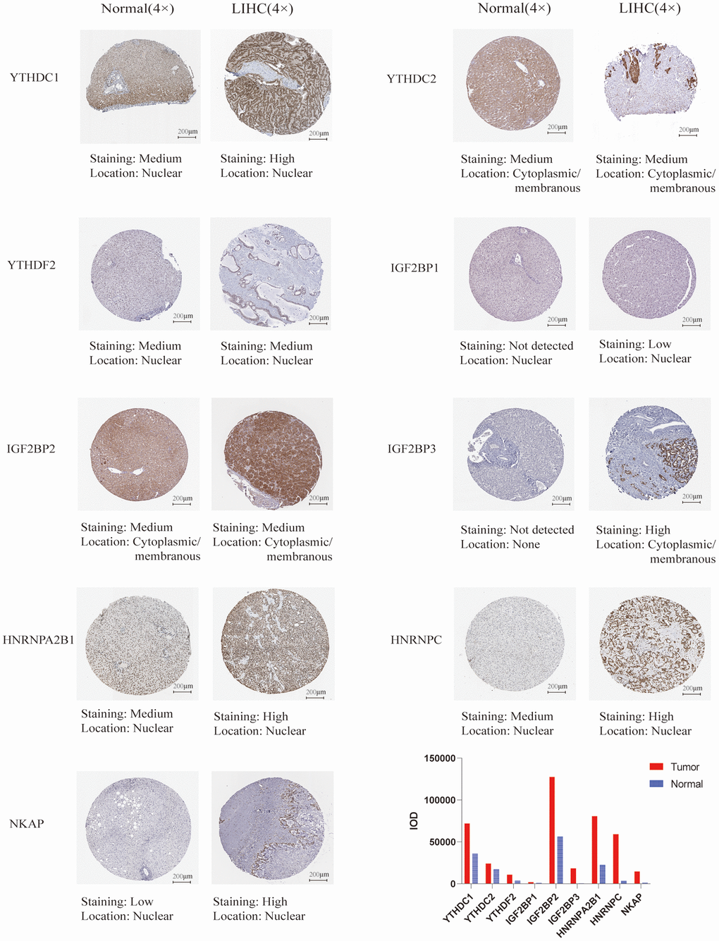 The protein expression of the m6A “readers” in HCC and normal liver tissues (the Human Protein Atlas database). The protein expression level of YTHDC1, YTHDC2, IGF2BP1, IGF2BP2, IGF2BP3, HNRNPA2B1, HNRNPC, and NKAP were higher in HCC tissue than in normal liver tissue. In addition, the integrated optical density (IOD) was used to analyze the expression difference between HCC tissues and normal liver tissues.