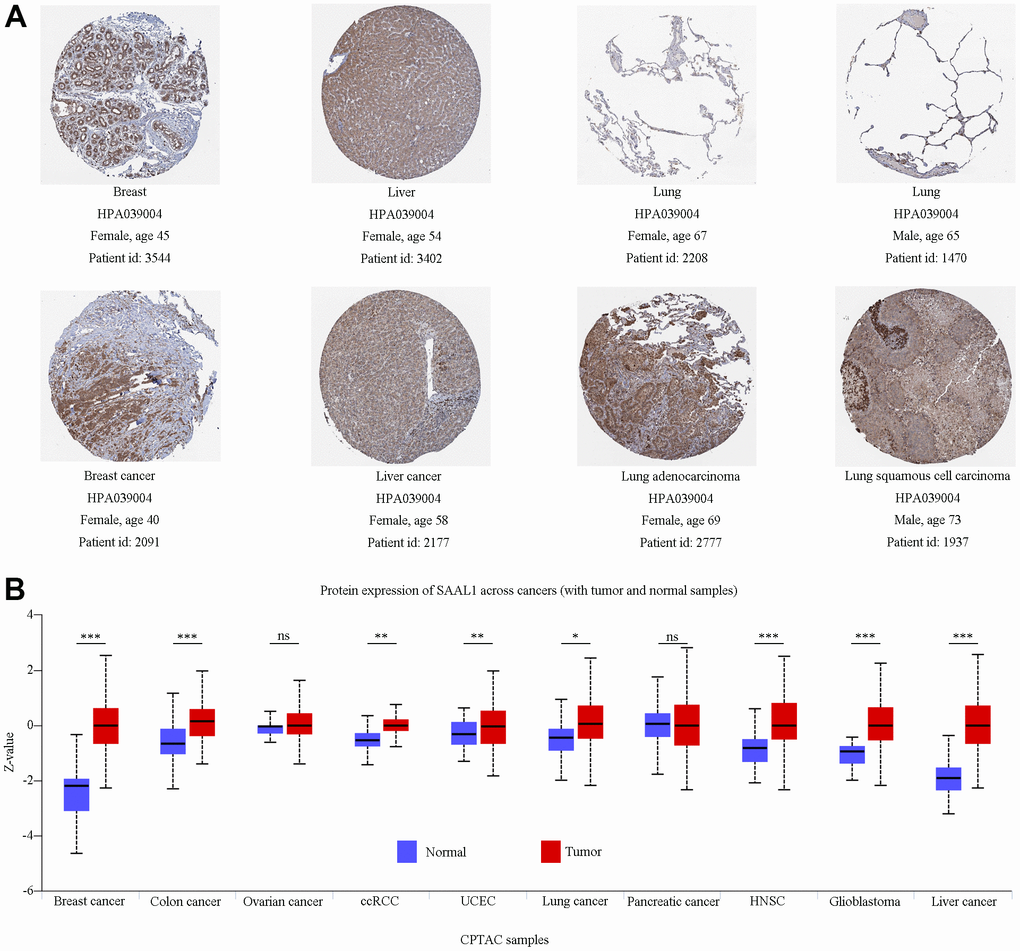 Analysis of SAAL1 protein expression. (A) Representative immunohistochemical staining for SAAL1 in normal and tumoral breast, liver, and lung tissues (images obtained from HPA). (B) SAAL1 protein expression levels in normal and tumor tissues. *P