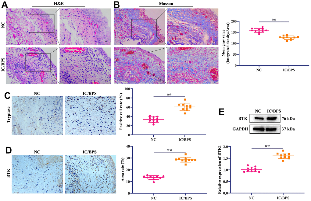 Differential expression of BTK in IC/BPS clinical samples. (A) HE staining shows the pathological state of IC/BPS samples. Scale bar: 100 and 50 μm. (B) Masson staining is used to distinguish collagen fibers from muscle fibers. Collagen fibers are blue and smooth muscle fibers are red. The staining results show that compared with NC group, collagen fibers in IC/BPS group are significantly reduced. Scale bar: 100 and 50 μm. (C, D) IHC staining showed the difference of (C) Tryptase and (D) BTK expression in normal and IC/BPS tissues. Scale bar: 20 μm. (E) Western blotting exhibited the expression level of BTK in normal and IC/BPS tissues. In all cases, Values are mean ± SD (n=10 for each group; *P