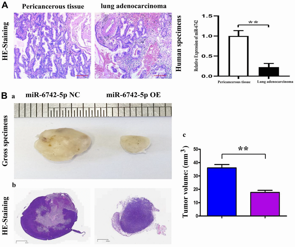 The expression of miR-6742-5p in human lung adenocarcinoma and its roles in nude mice. (A) Relative expression of miR-6742-5p in human lung adenocarcinoma and their paracancerous tissues, tested by quantitative real-time PCR. (B, a) the volume of H522 tumor in miR-6742-5p NC and OE group; (B, b) HE staining of nude mice’ tumors; (B, c) statistic data for tumor volume. (A) ** P=0.0001 miR-6742-5p OE group vs NC group; (B) **P=0.0001 miR-6742-5p OE group vs NC group.