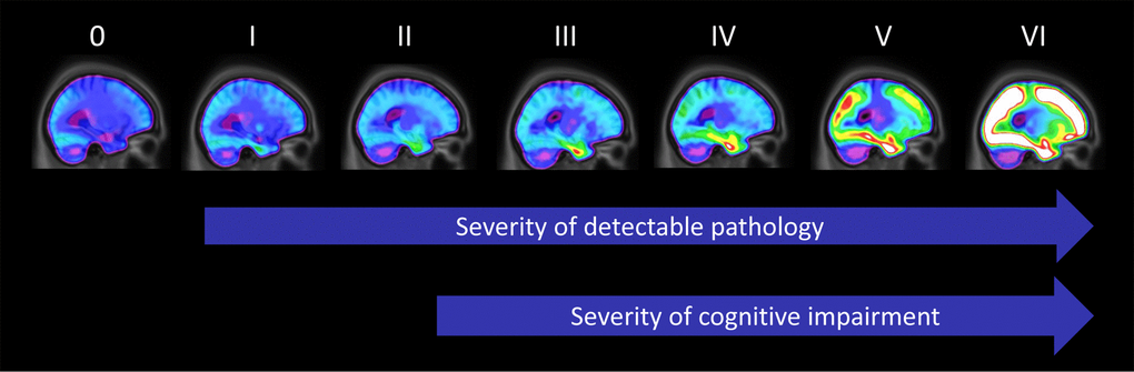 Progression of PET-based Braak stages .