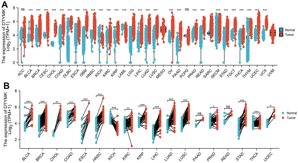 Expression pattern of DTYMK from the perspective of pan-cancer. (A) DTYMK was highly expressed in 24 of the 33 cancers compared with normal tissue. (B) Relative DTYMK expression in paired lung cancer and noncancerous tissues examined by TCGA databases. ACC: Adrenocortical carcinoma, BLCA: Bladder Urothelial Carcinoma, BRCA: Breast invasive carcinoma, CESC: Cervical squamous cell carcinoma and endocervical adenocarcinoma, CHOL: Cholangiocarcinoma, COAD: Colon adenocarcinoma, DLBC: Lymphoid Neoplasm Diffuse Large B-cell Lymphoma, ESCA: Esophageal carcinoma, GBM: Glioblastoma multiforme, HNSC: Head and Neck squamous cell carcinoma, KICH: Kidney: Chromophobe, KIRC: Kidney renal clear cell carcinoma, KIRP: Kidney renal papillary cell carcinoma, LAML: Acute Myeloid Leukemia, LUAD: Brain Lower Grade Glioma, LIHC: Liver hepatocellular carcinoma, LUAD: Lung adenocarcinoma, LUSC: Lung squamous cell carcinoma, MESO: Mesothelioma, OV: Ovarian serous cystadenocarcinoma, PAAD: Pancreatic adenocarcinoma, PCPG: Pheochromocytoma and Paraganglioma, PRAD: Prostate adenocarcinoma, READ: Rectum adenocarcinoma, SARC: Sarcoma, SKCM: Skin Cutaneous Melanoma, STAD: Stomach adenocarcinoma, TGCT: Testicular Germ Cell Tumors, THCA: Thyroid carcinoma, THYM: Thymoma, UCEC: Uterine Corpus Endometrial Carcinoma, UCS: Uterine Carcinosarcoma, UVM: Uveal Melanoma. NS: P >0.05,*P 