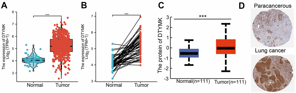 DTYMK RNA and protein expression in LUAD. (A) DTYMK mRNA expression levels in 535 lung cancer patients and matched adjacent normal samples. (B) Relative DTYMK expression in 54 paired lung cancer and noncancerous tissues. (C) DTYMK protein expression level based on CPTAC. (D) DTYMK protein levels based on Human Protein Atlas. ***P 