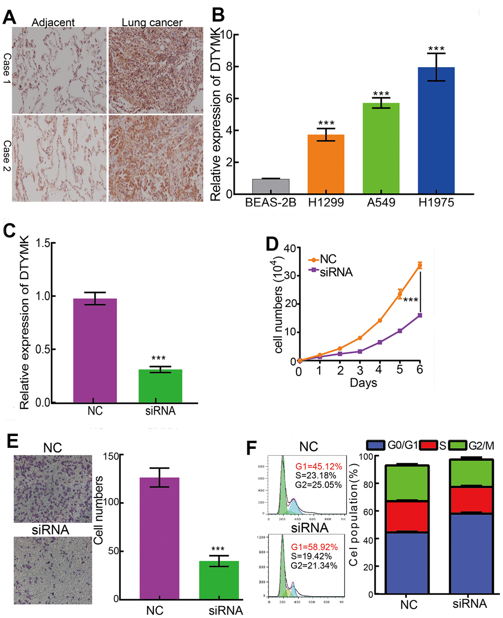 DTYMK regulates LUAD cell proliferation, migration and cell cycle. (A) IHC assay detect the protein of DTYMK in lung adenocarcinoma cancerous. (B) qPCR assay examine the expression level of DTYMK in lung adenocarcinoma cancerous cell lines, including A549, H1299, and H1975, compared to normal human bronchial epithelial cell line: BEAS-2B. (C) Establishment of DTYMK knockdown cell lines in H1975 verified by Real-time RT-PCR (D, E) Knockdown of DTYMK significantly inhibits cell proliferation and migration in H1975 cells, as measured by CCK8 and transwell assays. (F) Depletion of DTYMK increased G0/G1 phase arrested cells. NC=negative control, siRNA= DTYMK siRNA ***p 