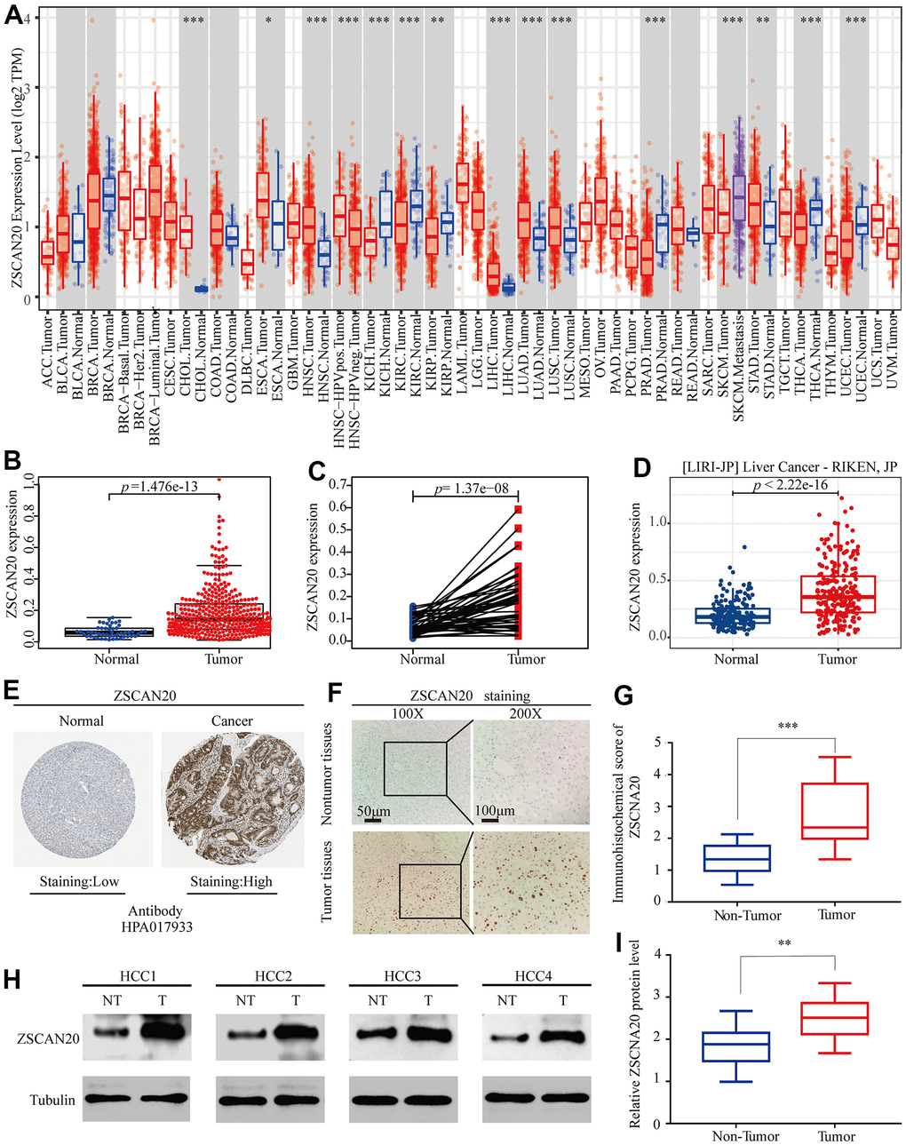 Expression of ZSCAN20 in HCC. (A) The expression level of ZSCAN20 in different types of tumor tissues and normal tissues in the TIMER database (P B) Expression levels of ZSCAN20 were higher than corresponding normal tissues in LIHC samples (TCGA-LIHC) (p=1.476e-13). (C) ZSCAN20 expression in 50 paired LIHC tissues and corresponding adjacent non-tumor tissues (TCGA-LIHC) (p=1.37e-08). (D) Expression levels of ZSCAN20 were higher than corresponding normal tissues in LIHC samples by using ICGC-LIRI-JP liver datasets. (E) ZSCAN20 protein expression in normal and LIHC tissues (HPA). (F) Typical images of immunohistochemistry (IHC) in 35 pairs of LIHC tissues showing the protein expression of ZSCAN20 in LIHC and adjacent non-tumor tissues. (G) Diagram of ZSCAN20 staining score in IHC staining. (H) The protein expression of ZSCAN20 in tumor tissues and adjacent normal tissues was detected by Western Blot, and the coloring depth represented the level of protein expression. (I) Quantification of ZSCAN20 protein expression based on western blot.