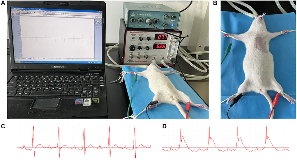 AMI model preparation. (A) After anaesthetized with an intraperitoneal injection of 2% pentobarbitone (0.2 ml/100 g), the rat was placed on a temperature control board for the surgical procedures. An intubation cannula connecting with a volume-controlled ventilator was plugged in trachea from its mouth. Three electrodes were subcutaneously placed into the three limbs of rat, and connected to a multi-channel recorder by which the electrocardiogram was recorded. (B) The fur at the left chest was shaved and the skin disinfected with 75% alcohol. (C, D) The echocardiography of rat before and after the coronary ligation; the ST segment elevation could be observed.