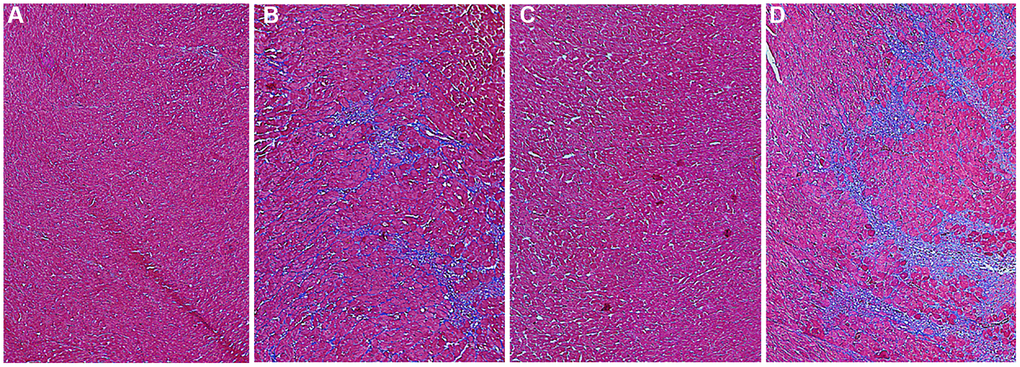 The collagen deposition of myocardial tissue in each group rats on the 7th day after AMI. To characterize myocardial tissue damage, the formalin-fixed and paraffin-embedded myocardial tissue sections were stained using a masson’s trichrome stain kit; by which collagen is stained blue, nucleus is dyed black; cytoplasma and muscle fibers is red. Stained sections were observed under optical microscopy, and were photographed by digital camera. (A–D) Photos of myocardial sections stained by masson G in rats of the Ctrl, HL, AMI, and HL-AMI group, respectively (×100).
