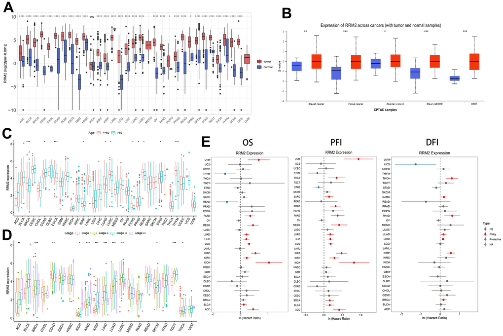RRM2 gene expression levels in different tumors and clinical data of cancer patients obtained from TCGA. (A) RRM2 gene expression levels in different cancer types and normal tissue from the TCGA and GTEx datasets. The red rectangle box represents the gene expression level in tumor tissue and the blue rectangle box in normal tissue. (B) Protein expression of RRM2 in breast cancer, ovarian cancer, colon cancer, clear cell RCC, and UCEC. The red rectangle box represents protein expression levels in tumor tissue and the blue one in normal tissue. (C) The RRM2 gene expression levels in patients belonging to different age groups. The red rectangle box indicates the RRM2 gene expression level in patients aged less than or equal to 60 years. The blue rectangle box indicates the RRM2 gene expression level in patients aged greater than 60 years. (D) The RRM2 gene expression levels in different tumors belonging to different pathological stages. The red rectangle box indicates the RRM2 gene expression level in stage I, the green one in stage II, the blue one in stage III, and the purple one in stage IV tumors. (E) Correlation analysis of RRM2 gene expression with OS, PFI, and DFI by the Cox regression analysis method in different types of cancers. * P 