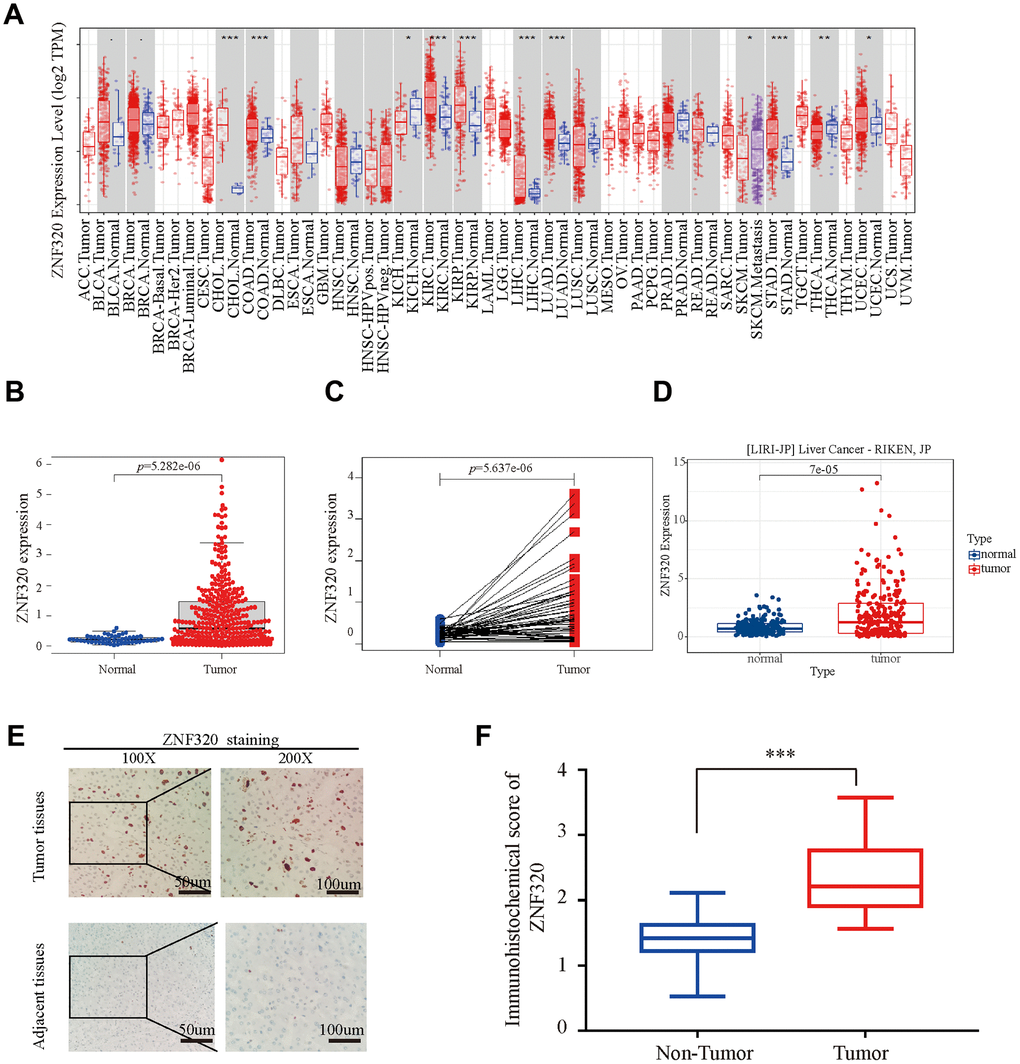 ZNF320 is over expressed in HCC tissues. (A) The mRNA level of ZNF320 in 33 kinds of tumor types by TIMER. (*pB) Expression levels of ZNF320 were higher than the corresponding normal tissues in HCC samples (p=5.282e-06). (C) ZNF320 expression in HCC group downloaded from TCGA RNA-seq dataset (p=5.637e-06). (D) The mRNA expression level of ZNF320 in tumor and normal tissues in the UALCAN (E, F) Typical images of immunohistochemistry (IHC) in 35 pairs of HCC tissues showing the protein expression of ZNF320 in HCC and adjacent nontumor tissues.