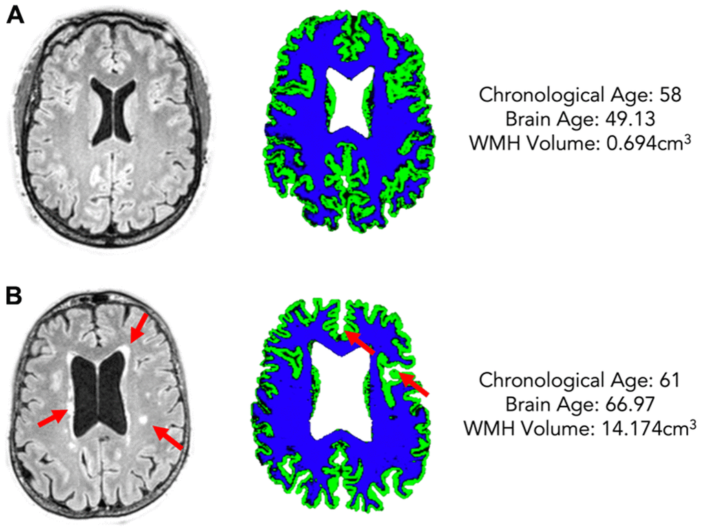 Two example participants of a similar chronological age (A: 58, B: 61) but different estimated brain age (A: 49.13, B: 66.97) and different WMH volume (A: 0.694cm3, B: 14.174cm3). The left column shows FLAIR scans with WMHs highlighted by red arrows, the right shows grey matter (green) and white matter (blue) maps for each participant.