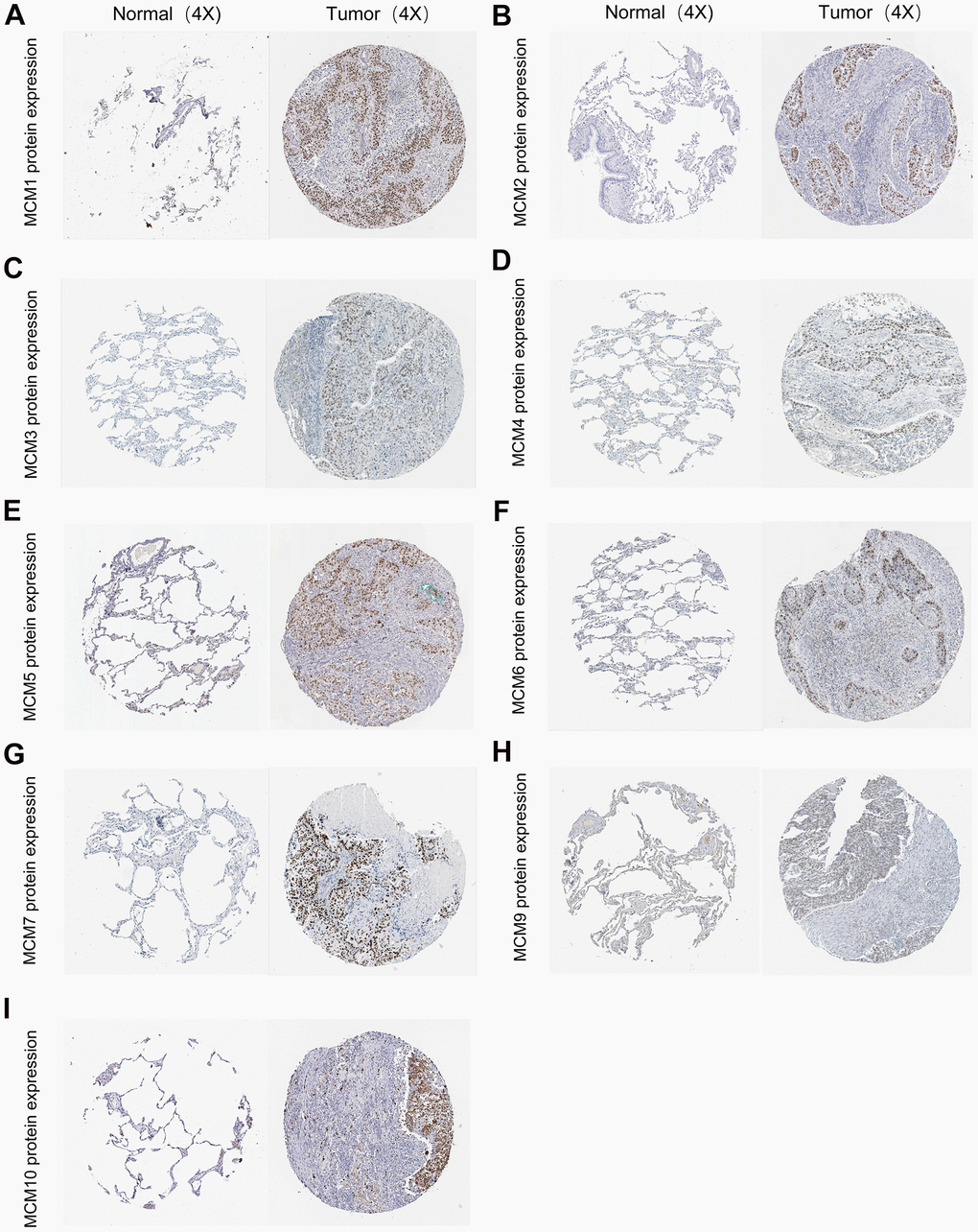 Typical immunohistochemistry images of minichromosome maintenance (MCM) family members. (A–I) Comparison of the expression of MCM1–10 in lung squamous cell carcinoma (LUSC) tissues with those in non-cancerous tissue (100×) using the data from the Human Protein Atlas database.