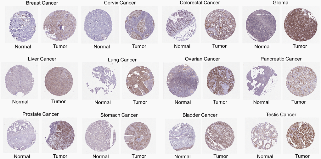 Immunohistochemical images of protein expression of RCC2 in various cancer types.