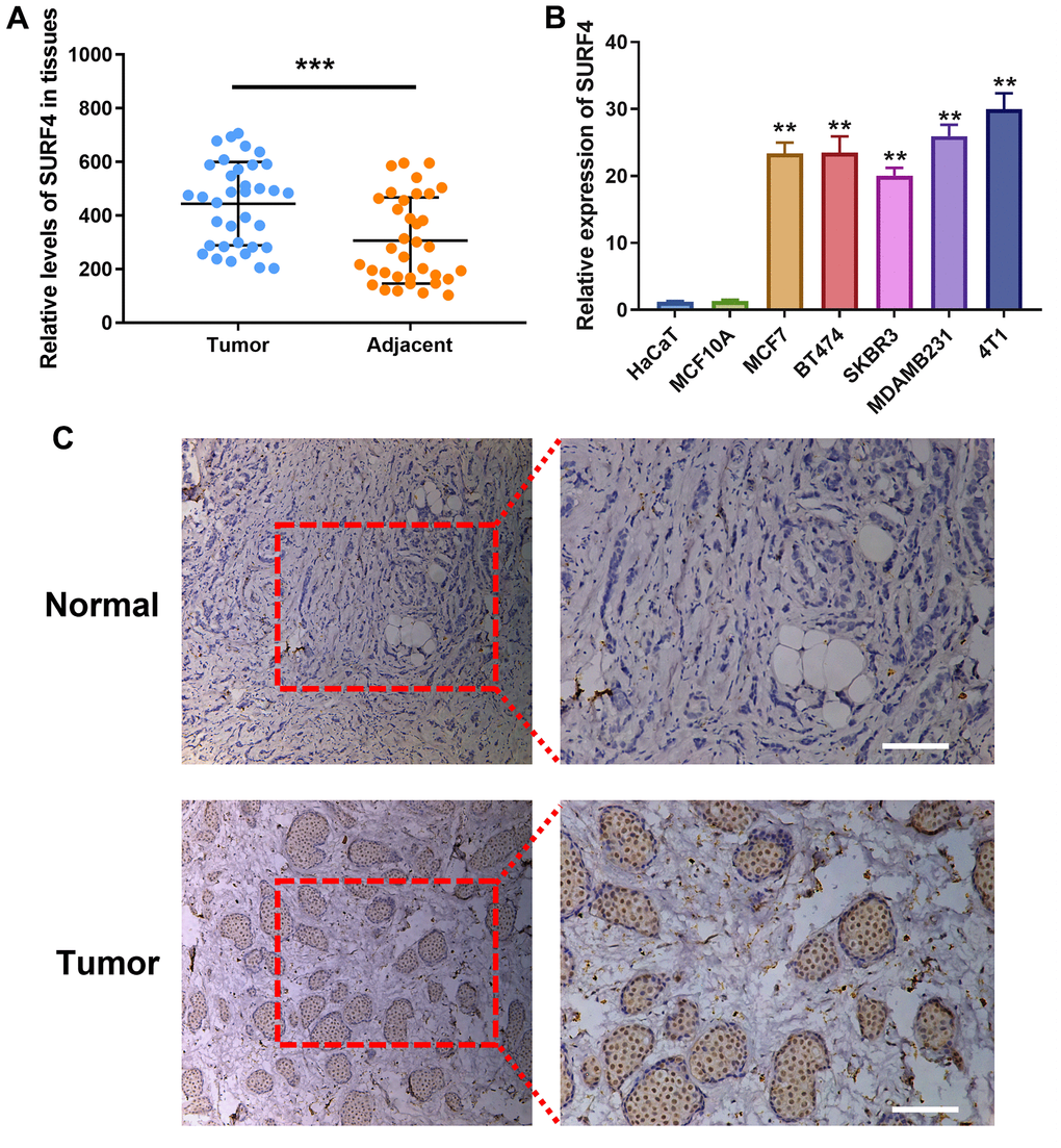 Expression of SURF4 in human breast tissues and cell lines. (A) SURF4 expression in tumor and adjacent normal tissue by qRT-PCR (N = 35). (B) SURF4 expression in HaCaT (Human immortalized epidermal cell), MCF10A (Human normal breast cell), MCF7 (Human luminal A type breast cancer cell), BT474 (Human luminal B type breast cancer cell), SKBR3 (Human HER2 overexpression type breast cancer cell), MDAMB231 and 4T1 (Human triple-negative breast cancer cell) by qRT-PCR in triplicate. (C) SURF4 expression in normal and tumor tissue by IHC. The tissues were from single patient. Scale bar = 100 μm. **P 