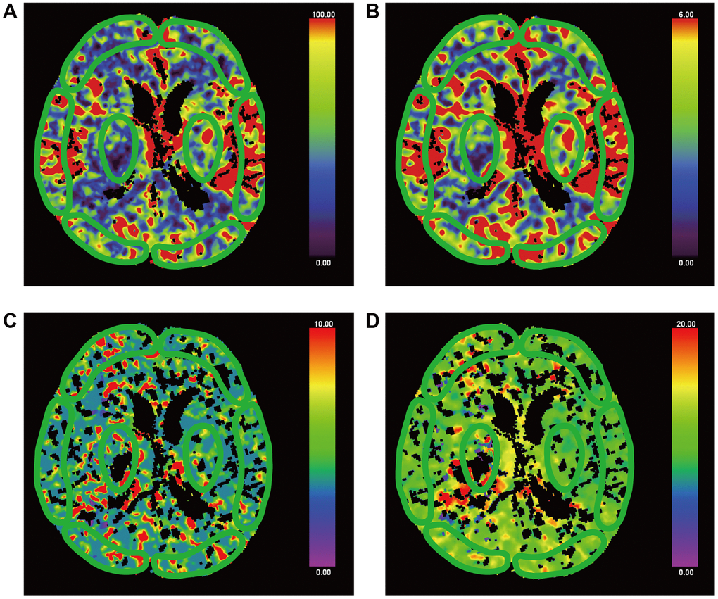False-colour pictures of a 76-year-old MCS− man after right thalamus hemorrhage at the basal ganglia level. The affected side is right. The damaged part is right thalamus. (A) The CBF map of the bilateral frontal cortex, temporal cortex, occipital cortex and thalamus, (B) the CBV map, (C) the TTP map and (D) the MTT map.