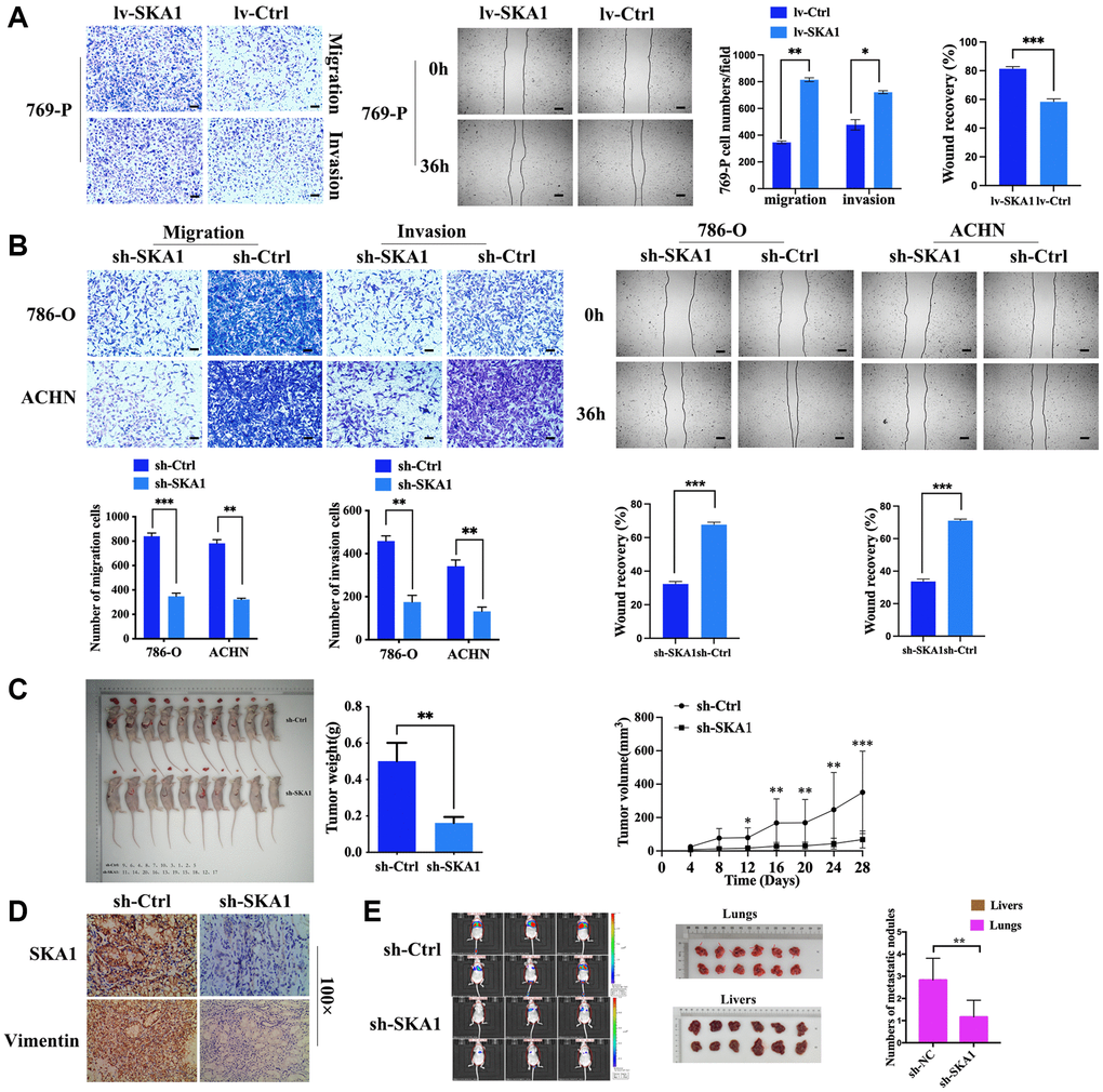 Knockdown of SKA1 attenuates tumor cell motility in vitro and in vivo. (A and B), Effects of SKA1 on the invasion and metastasis of RCC cells were confirmed by Transwell assay and wound healing assay. (C) The subcutaneous xenotransplantation model was established with 786-O cell line transfected with sh-SKA1 or sh-Ctrl. The length (L) and width (W) of tumors were measured once every four days for seven times after a six-week inoculation. At the end of investigation, mice were sacrificed and xenografts were then collected for diameter and weight measurements. (D) SKA1 and vimentin staining were performed in xenograft, scare bar: 100 μm. (E) Quantitation of tumor burdens determined by bioluminescence intensity, and numbers of metastatic nodules were counted in each group.