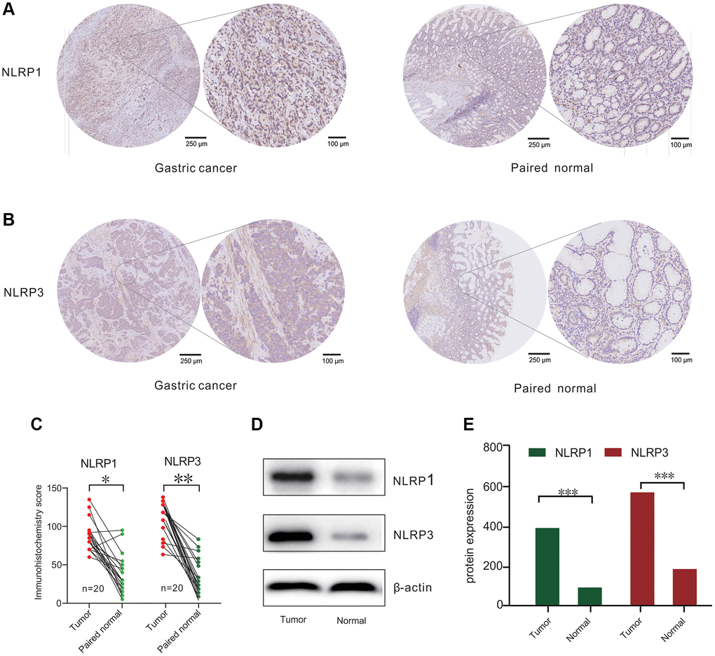 NLRP1/NLRP3 protein differently expressed in patients with gastric cancer (GC). (A and B) Representative Immunohisto-chemistry (IHC) staining for NLRP1 and NLRP3 from 20 gastric tissue and paired normal tissue. (C) IHC analysis for NLRP1/NLRP3 protein levels in 20 paired GC cases. (D) Representative Western blotting results of NLRP1/NLRP3 in 20 GC cases. (E) Histogram of NLRP1/NLRP3 protein expression level from 20 GC cases (*p **p ***p 