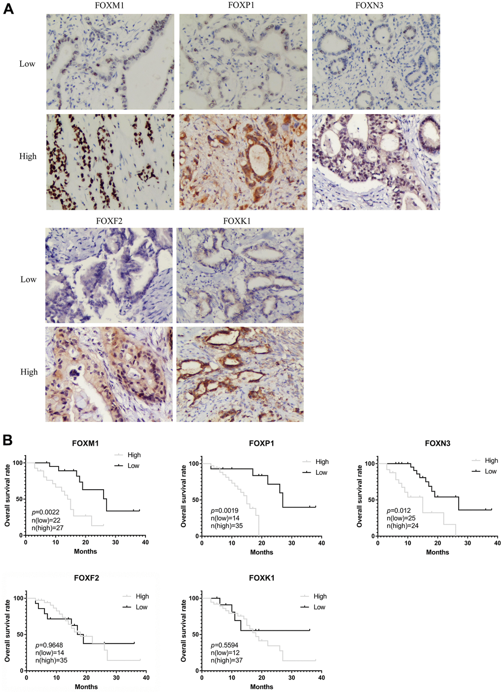 Validation of the prognostic role of FOXs in PAAD patient tissues. (A) Representative immunohistochemistry (IHC) images (200X) in PAAD tissues with low or high FOXM1, FOXP1, FOXN3, FOXF2, and FOXK1 protein levels. (B) Expression of FOXM1, FOXP1, and FOXN3 was negatively correlated with OS in PAAD patient pathology samples. Expression of FOXF2 and FOXK1 had no significant correlation with OS.