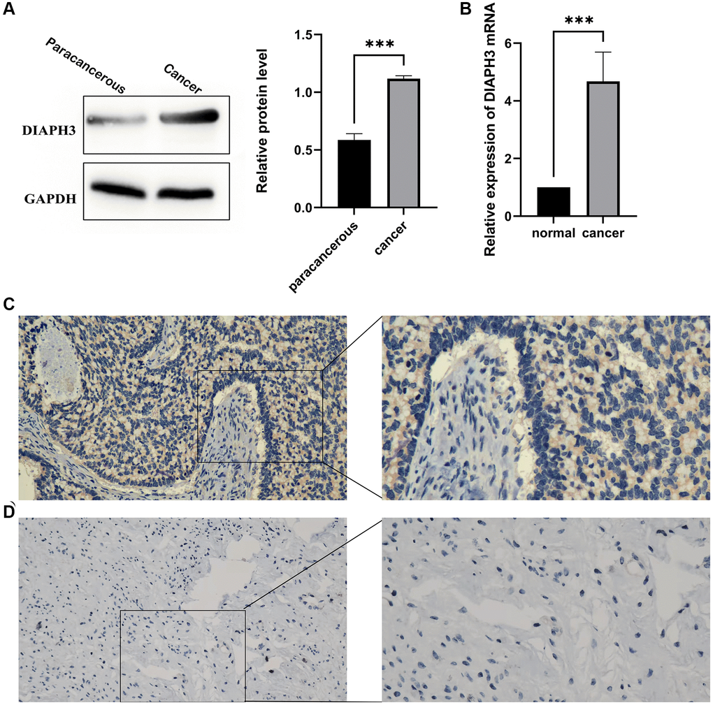 Expression of Diaphanous Related Formin 3 (DIAPH3) in cancer and normal tissues. (A) Western blot to verify the expression of DIAPH3 in cancer and normal cervical tissues (the experiment was repeated thrice). (B) Quantitative reverse transcription-polymerase chain reaction (qRT-PCR) to verify the expression of DIAPH3 in cancer and normal cervical tissues (the experiment was repeated four times). (C) The expression of DIAPH3 in cancer tissue verified by immunohistochemistry. (D) The expression of DIAPH3 in normal cervical tissue verified by immunohistochemistry. *p 