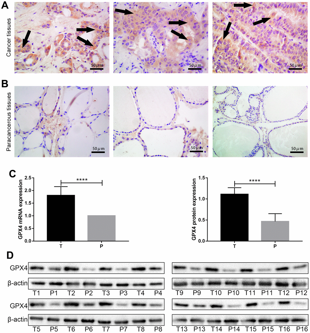 GPX4 expression in thyroid cancer tissues and paracancerous tissues. High expression of GPX4 in thyroid cancer tissues (A) and low expression of GPX4 in paracancerous tissues (B) based on immunohistochemistry (Original magnification×40); scale bars: 50 μm. Expression of GPX4 at the mRNA level (C) and protein level (D) in different tissues (T, thyroid cancer tissues; P, paracancerous tissues, N=16). ****p