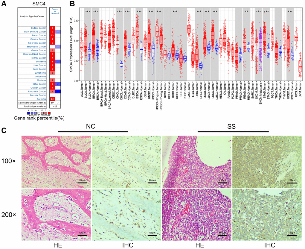 Expression and prognostic value of SMC4 in various cancers. (A) The differential expression of SMC4 in multiple cancer tissues compared to normal tissues using the Oncomine database; (B) SMC4 expression in various cancers from TCGA database. Note: *p **p ***p C) The Expression of SMC4 in synovial sarcoma tissue. Abbreviations: NC: normal control; SS: synovial sarcoma.