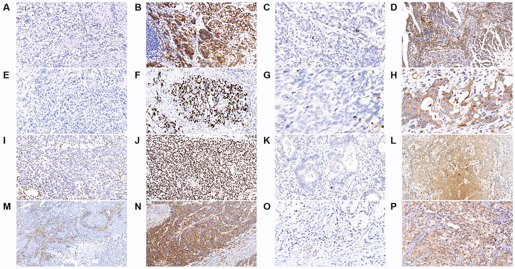 The results of immunohistochemical staining in gastric cancer tumor samples are shown as follows in the figures. (A) E-cadherin-negative (B) E-cadherin-positive (C) MACF1-negative (D) MACF1-positive (E) p53-negative (F) p53-positive (G) PLB1-negative (H) PLB1-positive (I) ARID1A-negative (J) ARID1A-positive (K) KMT2C-negative (L) KMT2C-positive (M) FAT4-negative (N) FAT4-positive (O) KMT2D-negative (P) KMT2D-positive. (x400).
