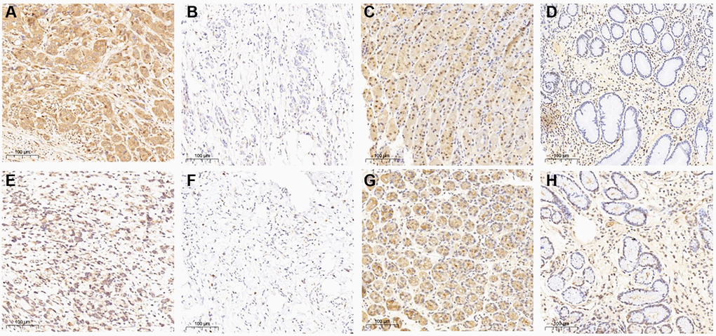 THBS2 and VCAN expression in gastric cancer and gastritis by immunohistochemistry. THBS2 protein was mainly expressed at the cytoplasm. The expression of THBS2 protein in gastric cancer was significantly higher than that in gastritis (P = 0.003). (A) Positive expression of THBS2 protein in gastric cancer; (B) Negative expression of THBS2 protein in gastric cancer; (C) Positive expression of THBS2 protein in gastritis; (D) Negative expression of THBS2 protein in gastritis. VCAN protein expressed mainly at the cytoplasm and cell membrane. The expression of VCAN protein in gastric cancer was significantly higher than that in gastritis (P E) Positive expression of VCAN protein in gastric cancer; (F) Negative expression of VCAN protein in gastric cancer; (G) Positive expression of VCAN protein in gastritis; (H) Negative expression of VCAN protein in gastritis.