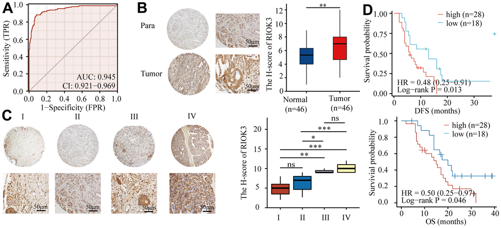 RIOK3 protein is highly expressed in PDAC tissues and associated with poor prognosis. (A) ROC curve of RIOK3 mRNA for prediction PDAC in TCGA and GTEx datasets (AUC=0.954, 95%CI:0.921-0.969) (n=350, 171 Normal and 179 Tumor). (B) Representative IHC staining of RIOK3 and IHC analysis of RIOK3 expression in PDAC and paired adjacent normal tissue (n=46; p=0.004). Paired samples Wilcoxon test. (C) Representative IHC staining of RIOK3 and IHC Immunohistochemical analysis of RIOK3 expression in different stages of PDAC tissues (n=46; 15 Stage I, 21 Stage II, 3 Stage III, and 7 Stage IV; F = 17.331, P D) Kaplan–Meier curves of DFS and OS analysis of RIOK3 expression in PDAC patients (n=46, 28 high-RIOK3 and 18 low-RIOK3). The star (*) symbol denotes the level of statistical significance: * p 