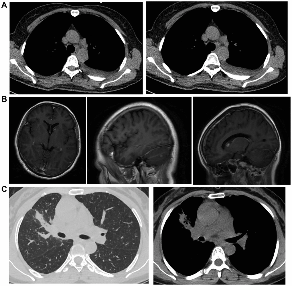 The MRI images of metastatic lung cancer patients. (A) MRI image of mediastinal lymph node metastasis and left side pleural effusion. (B) MRI image of brain metastatic non-small cell lung cancer. (C) MRI image of non-small cell lung cancer in the upper lobe of the right lung with metastasis in both lungs and mediastinum.