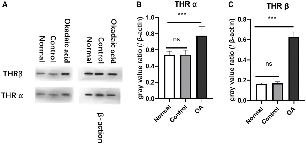 Expression of thyroid receptors in hippocampus of mice. Two weeks after stereotaxic injection, the expression of THRα and β in the hippocampus of the three groups of mice were detected by Western blot (A). The gray value analysis showed that the expression of THRα (B) and THRβ (C) protein were significantly higher than those of the normal and control group (****P P = 0.987 and 0.584, respectively). Normal: Mice without stereotactic puncture; control: The mice were punctured stereotaxically and injected with 5 μL of normal saline; OA: Mice were subjected to stereotactic puncture and injection of 5 μL of 0.1 μM okadaic acid. (LSD test, n = 6).