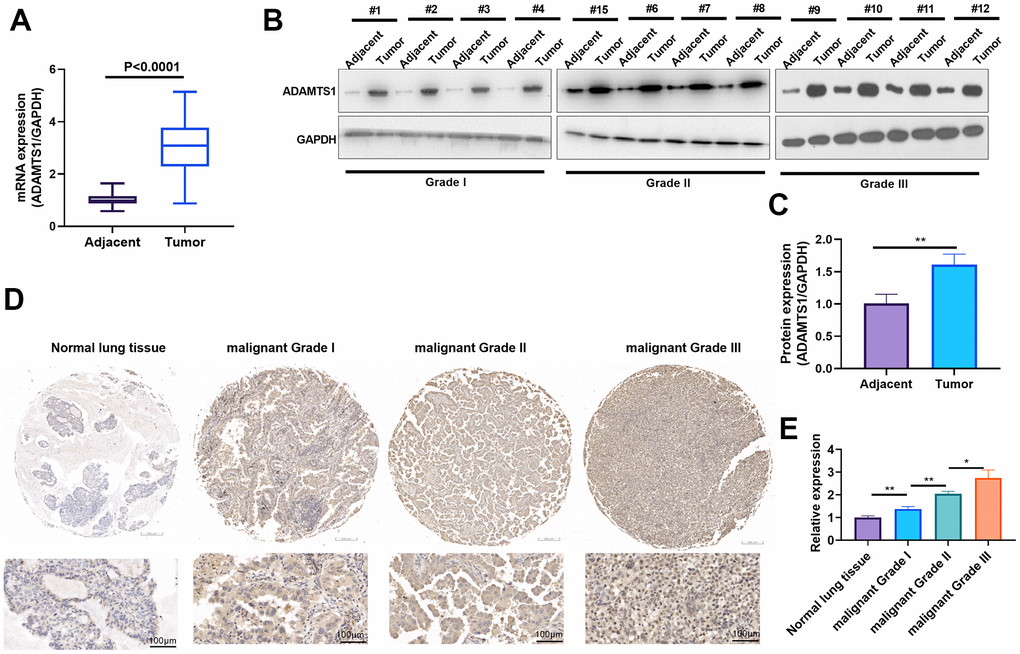 ADAMTS1 is up-regulated in non-small cell lung cancer tumor tissues. (A) qRT-PCR was conducted the mRNA expression of ADAMTS1 in NSCLC tumor tissues than that in adjacent normal tissues. (B, C) Western blot was used for evaluating the protein expression of ADAMTS1 in NSCLC tumor tissues and adjacent normal tissues with different clinical grades (n=12). (D, E) The expression of ADAMTS1 was detected in NSCLC tissues and adjacent normal tissues, (scale bar=100 μm). *PP