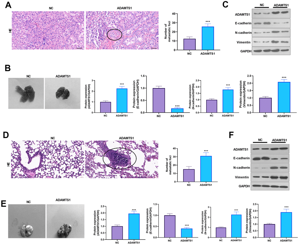 ADAMTS1 promotes lung metastasis of tumor cells in mice. A549 (A–C) and H226 cells (D–F) with ADAMTS1 upregulation were used for constructing an in vivo lung metastasis model in nude mice. (A) HE staining was used for detecting the pathological changes in lungs from mice injected with A549 cells. (B) The gross image of the lung. (C) Protein expression of E-cadherin, N-cadherin, and Vimentin in the lung tissues of nude mice was detected using Western blot. (D) HE staining was used for detecting the pathological changes in the lung from mice injected with H226 cells. (E) The gross image of the lung. (F) Protein expression of E-cadherin, N-cadherin, and Vimentin in the lung tissues of nude mice was detected using Western blot. ***P