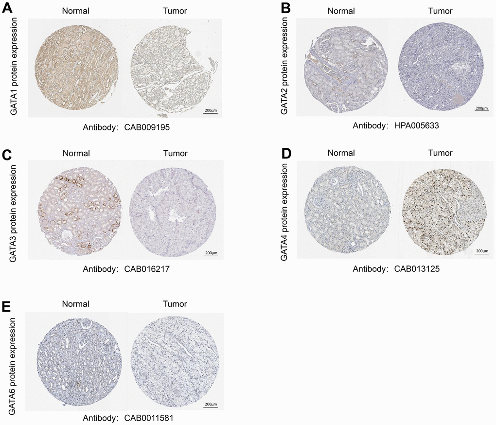 Representative immunohistochemistry images of the GATA family members. (A–E) The HPA database shows the protein expression levels of GATA1-6 in KIRC tissues compared with those in non-cancerous tissue. HPA, Human Protein Atlas; KIRC, kidney renal clear cell carcinoma.