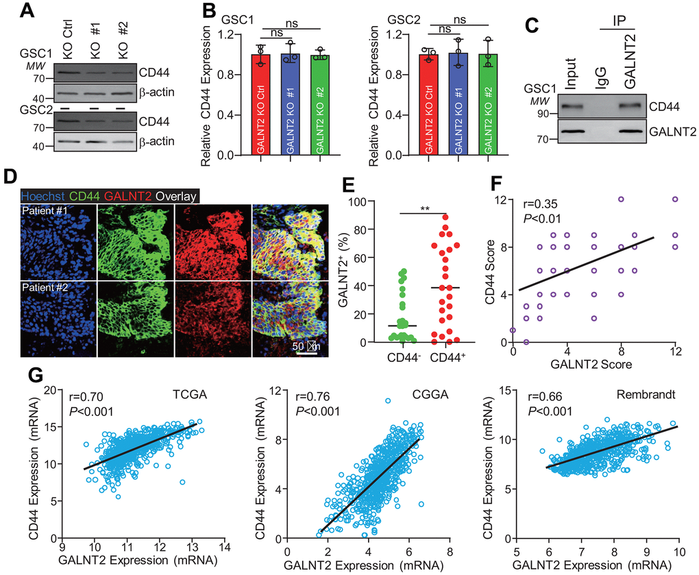 GALNT2 promotes CD44 expression. (A) Silencing GALNT2 significantly inhibits CD44 protein expression. (B) Silencing GALNT2 did not alter CD44 mRNA expression. ns indicates non significance. (C) GALNT2 interacts with CD44. IgG was used as a negative control. (D) GALNT2 co-localized with CD44 in GBM clinical specimens. Scale bar: 50 μm. (E) GALNT2 was preferentially expressed in CD44 positive cells. (F) GALNT2 protein expression was highly correlated with CD44 expression in GBM specimens. (G) GALNT2 mRNA expression was highly co-related with CD44 mRNA expression in TCGA (left panel) and CGGA (middle panel), and Rembrandt (right panel). ** indicates p 