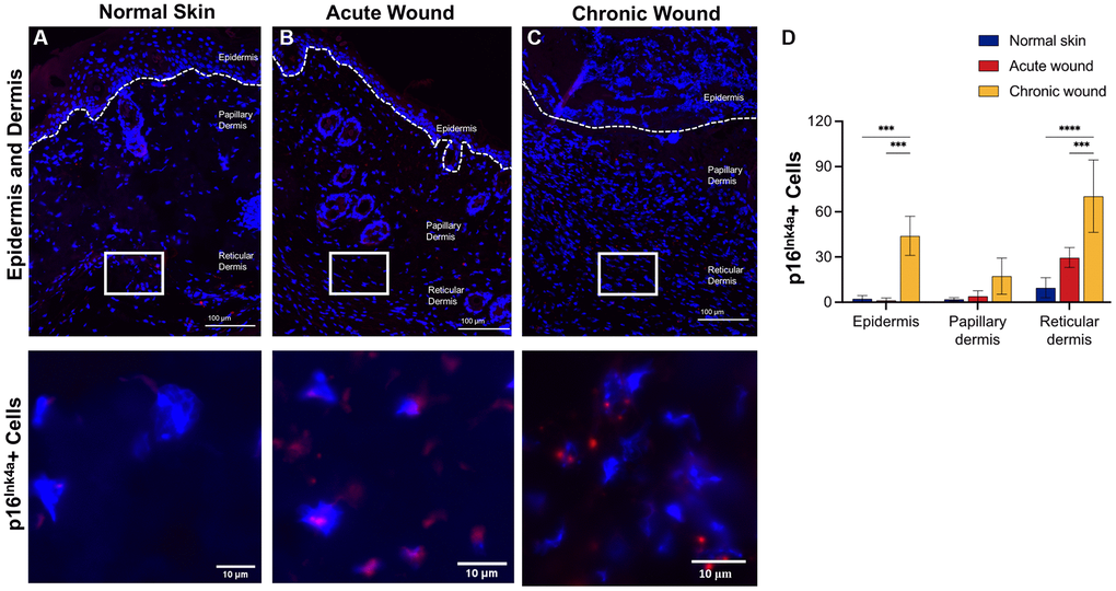 p16Ink4a RNA-ISH transcription is upregulated in dermal tissues in chronic wounds. Representative RNA-ISH images showing p16Ink4a nuclear localization in (A) normal skin, (B) an acute wound, and (C) a chronic wound, 20× magnification (top) and focused zoom (bottom) (n = 6 in each group at day 14). (D) Quantification of p16Ink4a positive cells in epidermis, papillary dermis, and reticular dermis. Measurements are expressed as mean ± SEM. Statistical analysis was performed using Student’s t-test; ***p ****p in situ hybridization.