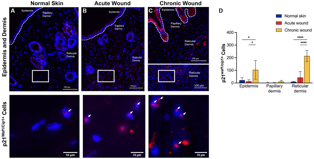 p21Waf1/Cip1 RNA-ISH transcription is upregulated in both epidermal and dermal tissues in chronic wounds. Representative RNA-ISH images showing p21Waf1/Cip1 nuclear localization in (A) normal skin, (B) an acute wound, and (C) a chronic wound, 20× magnification (top) and focused zoom (bottom) (n = 6 in each group at day 14). (D) Quantification of p21Waf1/Cip1 positive cells in epidermis, papillary dermis, and reticular dermis. Measurements are expressed as mean ± SEM. Statistical analysis was performed using Student’s t-test; *p ****p in situ hybridization.