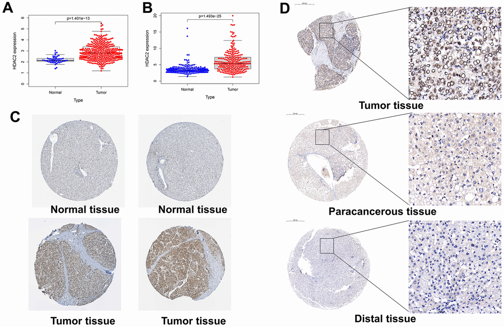 Expression levels of HDAC2 in different tissues. (A) HDAC2 expression in normal and tumor tissues in the TCGA-LIHC cohort. (B) HDAC2 expression in normal and tumor tissues in the ICGC-JP cohort. (C) The protein level of HDAC2 in normal and tumor tissues in HPA database. (D) The protein levels of HDAC2 in tumor tissue, paracancerous tissue, and distal tissue in the tissue microarray.
