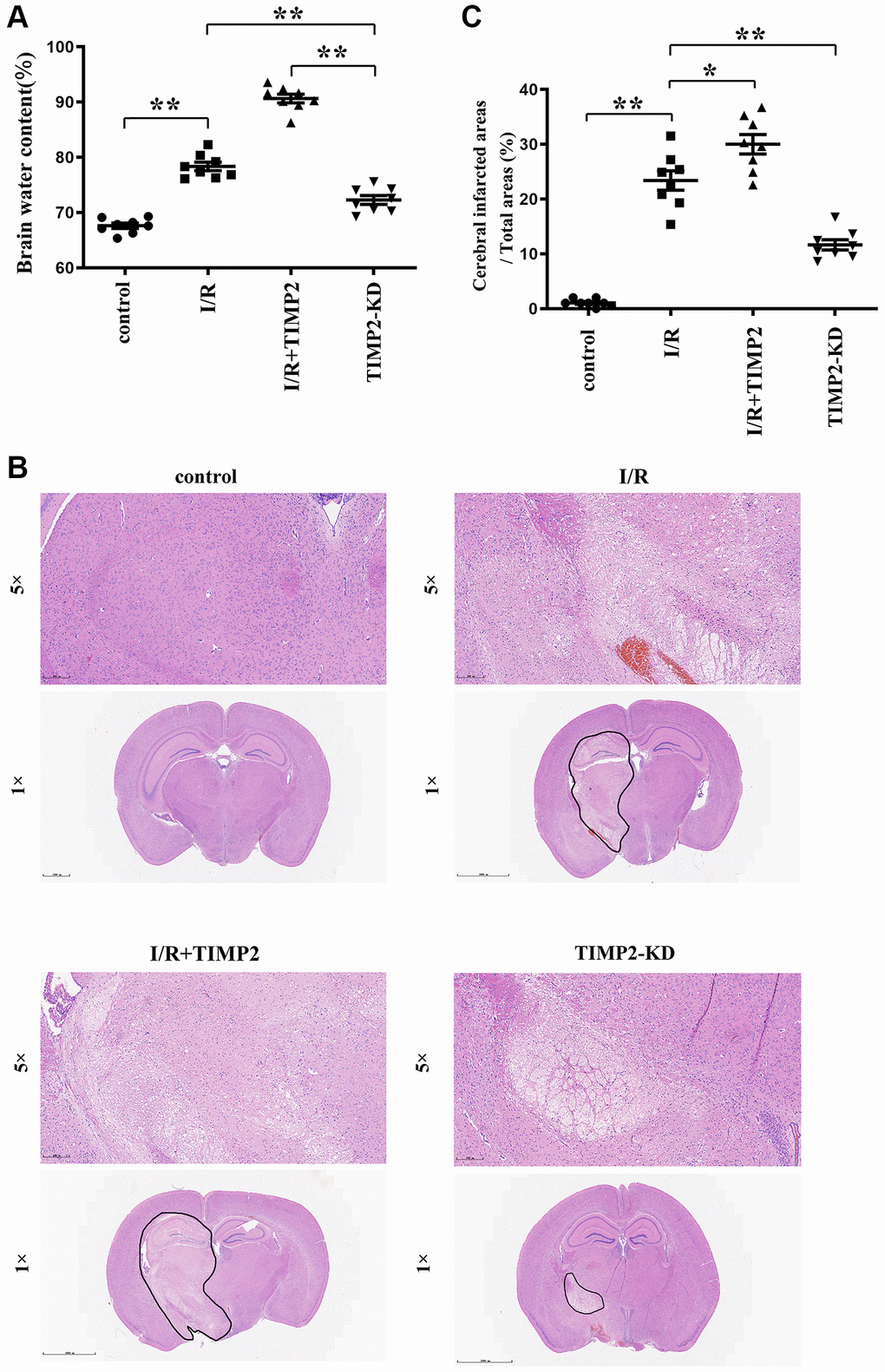 TIMP2 can aggravate brain water content and brain tissue damage in CIRI mice. (A) Brain water content is measured in the control group, I/R group, and I/R+TIMP2 group. Brain water content is significantly higher in the I/R group than that in the control group. Furthermore, the use of TIMP2 further increases brain water content in the I/R group. In contrast, brain water content is significantly reduced in the TIMP2-KD group. (B, C) Pathological changes in brain tissues are observed using HE staining in the control group, I/R group, and I/R+TIMP2 group. No pathological changes are observed in the control group, whereas mice in the I/R+TIMP2 group showed larger pathological changes compared with the I/R group. Conversely, the pathological area in the brain tissues of mice in the TIMP2-KD group becomes smaller. **P *P 