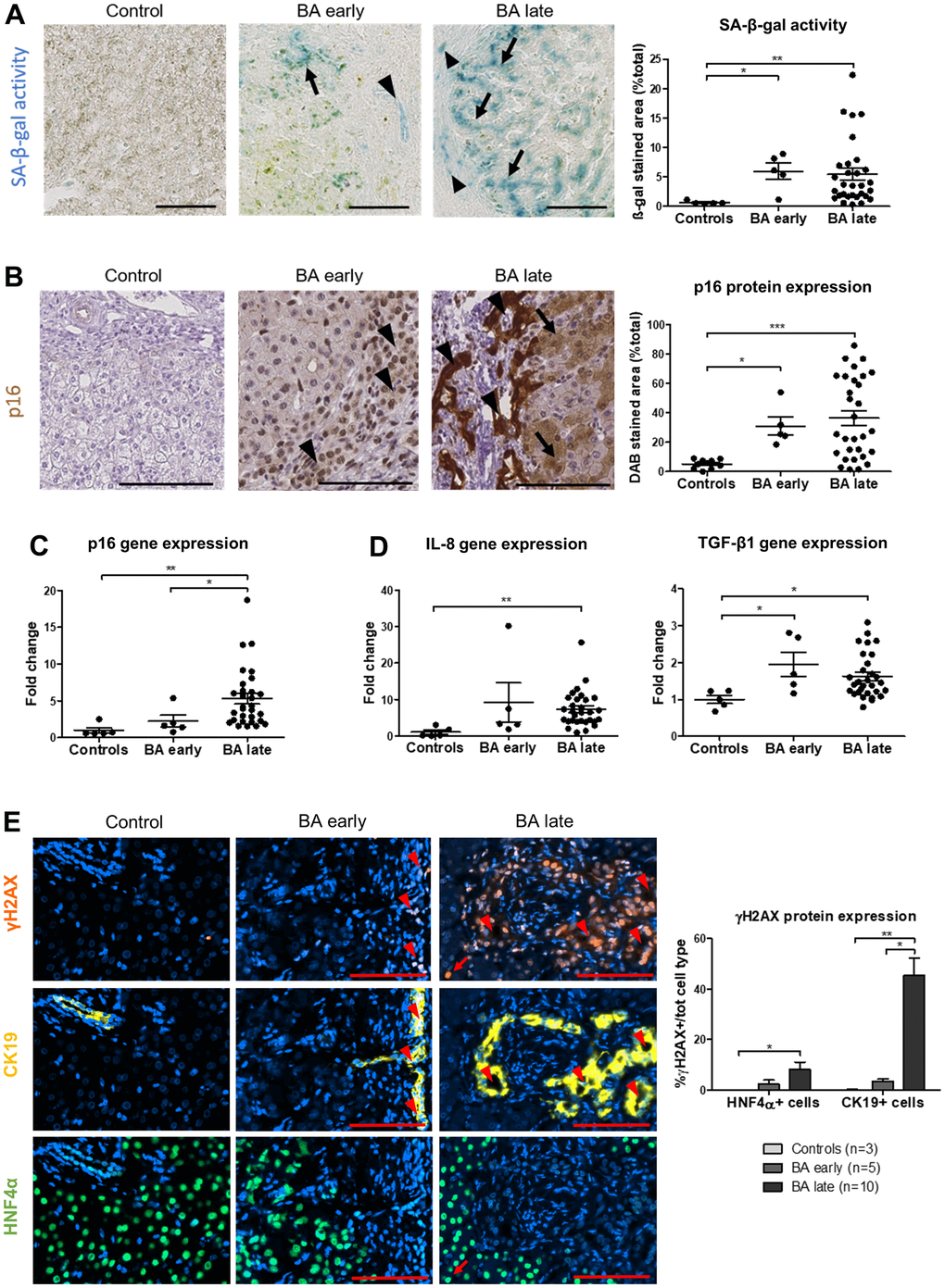 Senescence increases in BA livers and predominates in cholangiocytes and perinodular hepatocytes. (A) SA-β-gal activity increases in cholangiocytes (arrowheads) and surrounding perinodular hepatocytes (arrows) in BA livers. (B) p16 protein expression also increases in cholangiocytes (arrowheads) and surrounding perinodular hepatocytes (arrows) in BA livers. (C) Gene expression of p16 progresses until liver transplantation in BA. (D) Gene expression of SASP markers IL-8 and TGF-β1 increase in BA livers versus controls. (E) DNA damage γH2AX-positive foci increase in both hepatocytes and cholangiocytes in BA livers and progress until liver transplantation in cholangiocytes. BA: biliary atresia; DAB: 3,3′-diaminobenzidine; SA-β-gal: senescence-associated beta-galactosidase; Data is presented as mean ± SEM; *p≤0.05, **p