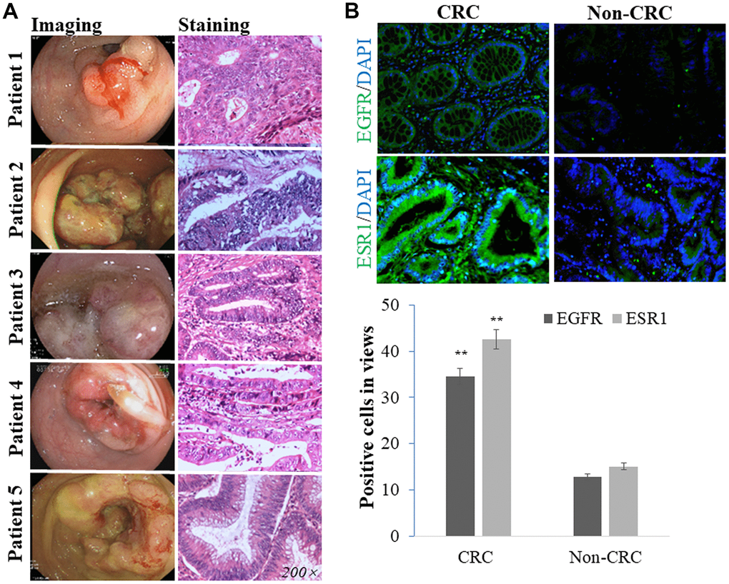 Patients clinically diagnosed with CRC through imaging and HE staining tests (A). The intracellular EGFR and ESR1 positive expressions detected in human CRC samples were more than those in non-CRC sections (B).