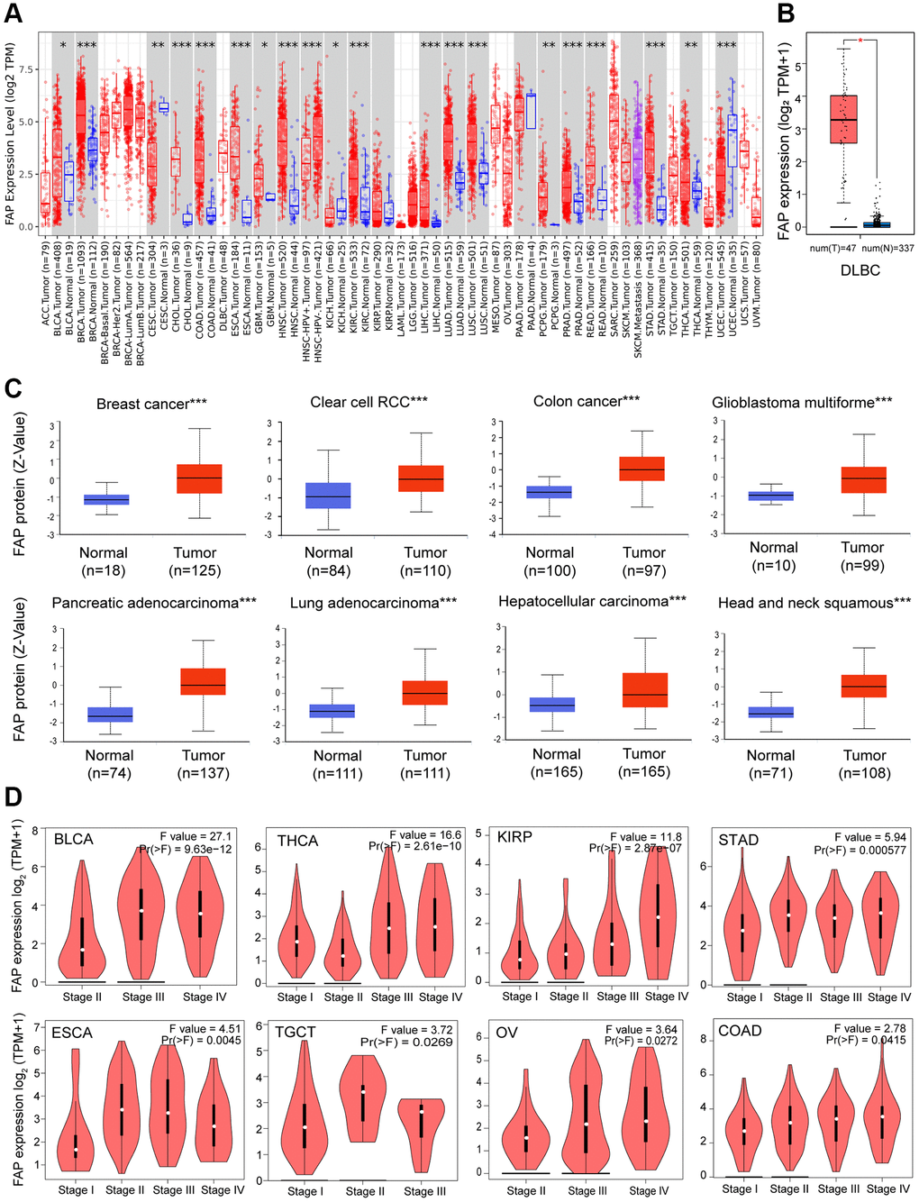 FAP expression profile in human cancers. (A) Human FAP expression levels in different cancer types from the TCGA database. The statistical significance was computed by the Wilcoxon test. (B) For DLBC in the TCGA, normal tissues from the GTEx dataset were included as controls. (C) FAP protein expression levels in various cancers compared with normal controls. (D) FAP gene expression was studied according to pathological stages. *P **P ***P 