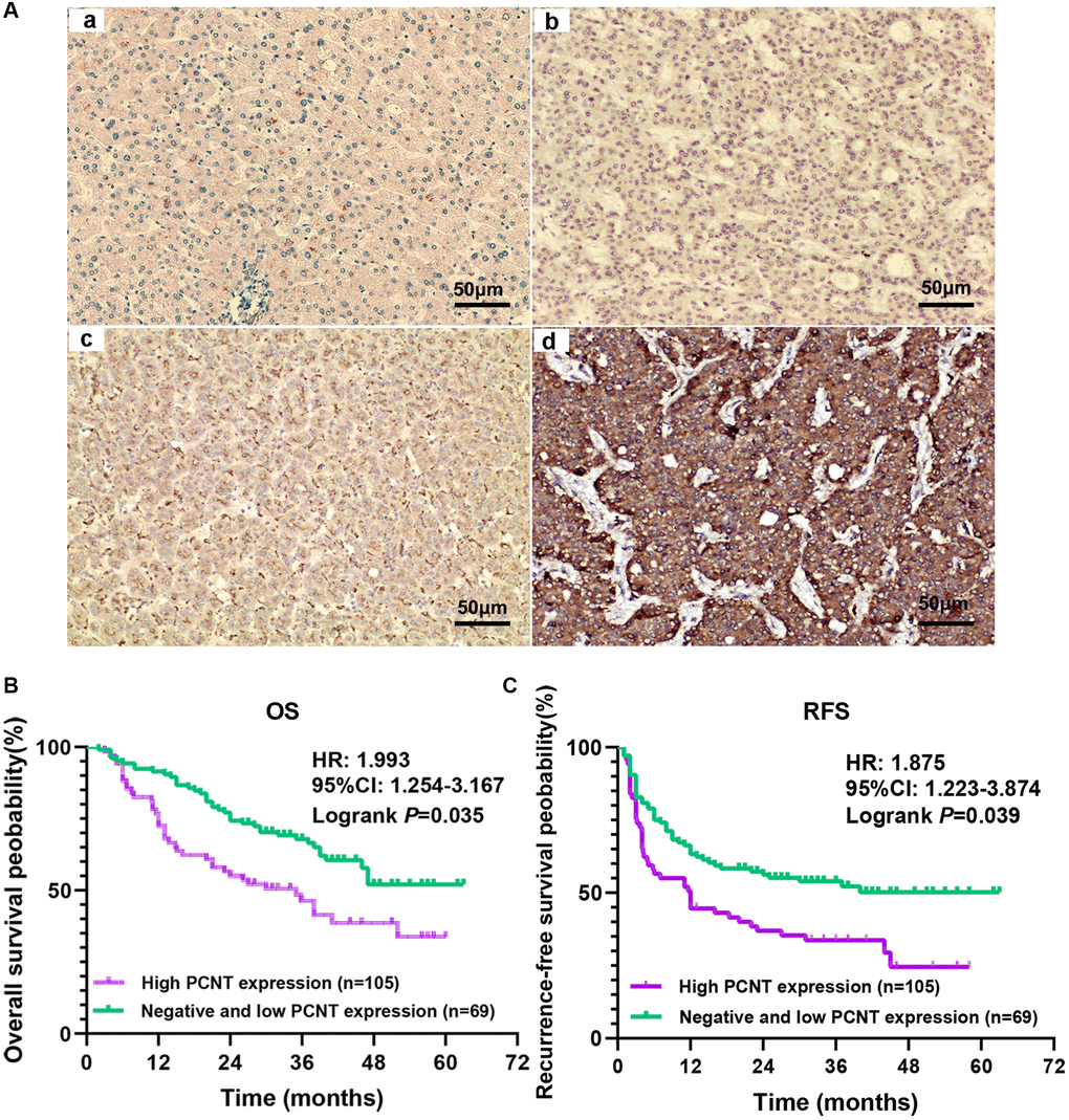 Expression and prognostic role of PCNT protein in HCC. (A) The representative images of adjacent normal liver tissues (a) and negative (b), low (c), and high (d) PCNT protein expression HCC tissues. (B, C) Higher PCNT protein expression correlated to shorter OS (B) and RFS (C) periods in HCC patients.
