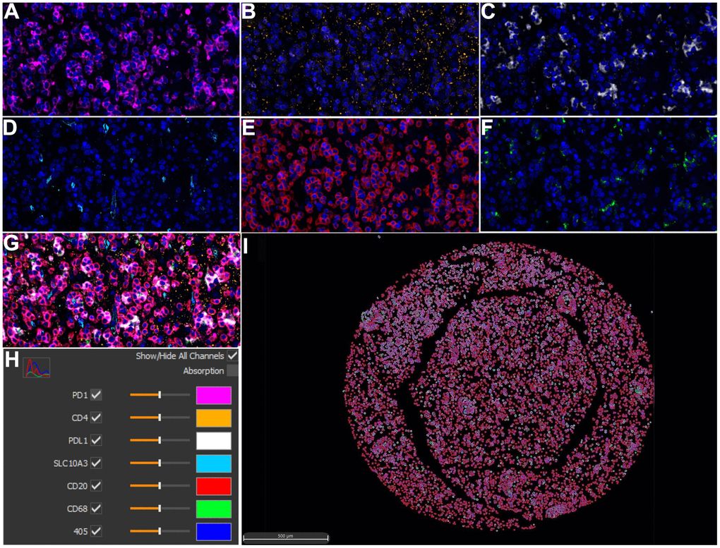 Multiplex immunohistochemistry profiling of SLC10A3 and immune markers in LGG. (A) PD1 (pink), (B) CD4 (yellow), (C) PD-L1 (white), (D) SLC10A3 (blue). (E) CD20 (red), (F) CD68 (green). (G) The merged image of seven markers. (H) Each marker stands for one special color. (I) Cell phenotype image constructed by the seven markers in the multiplex staining.