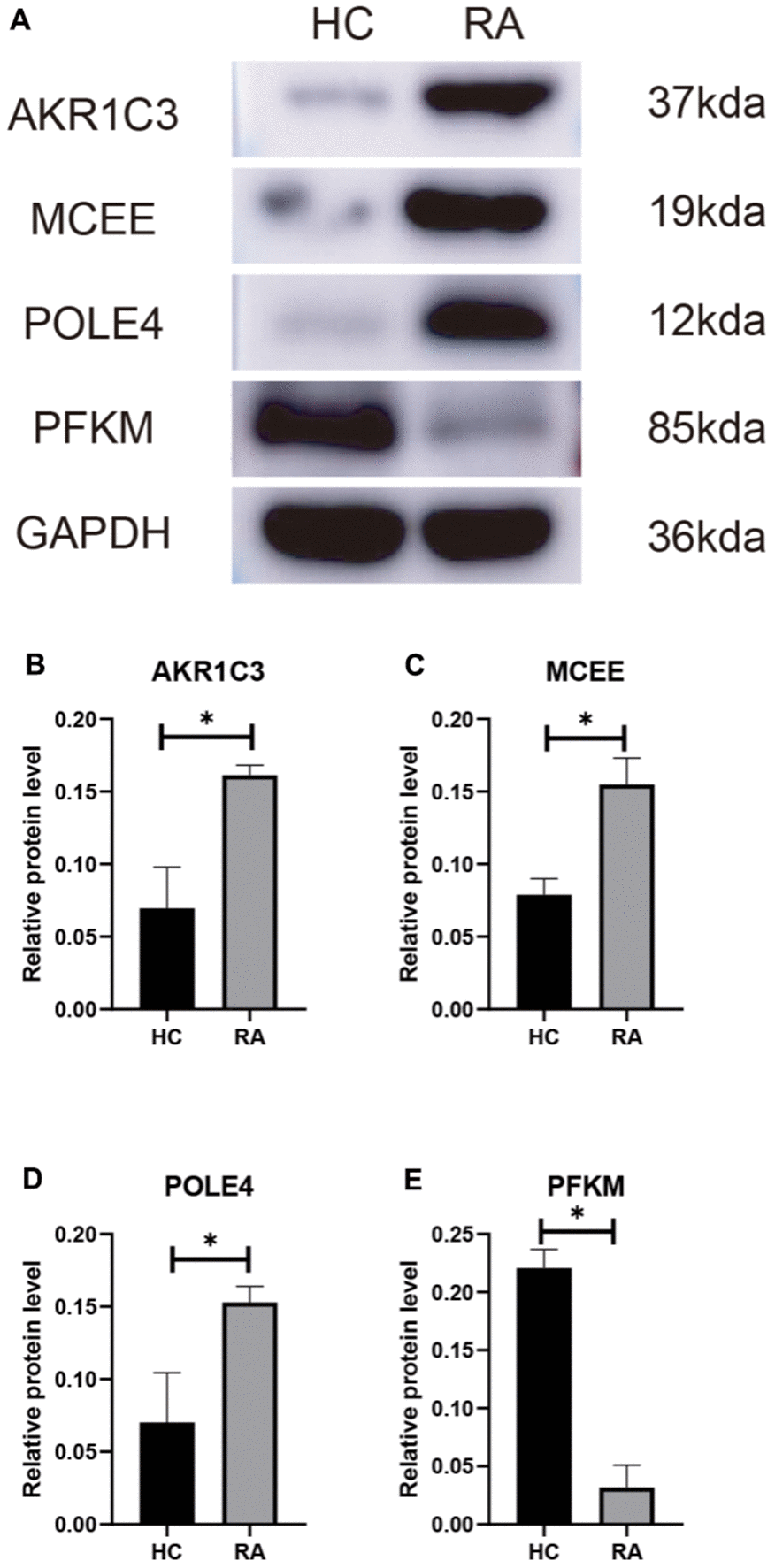 (A) Validation of 4 diagnostic feature biomarkers in clinical tissues via western blot analysis. The expression of (B) AKR1C3, (C) MCEE, (D) POLE4 and (E) PFKM. Statistical significance: *P 