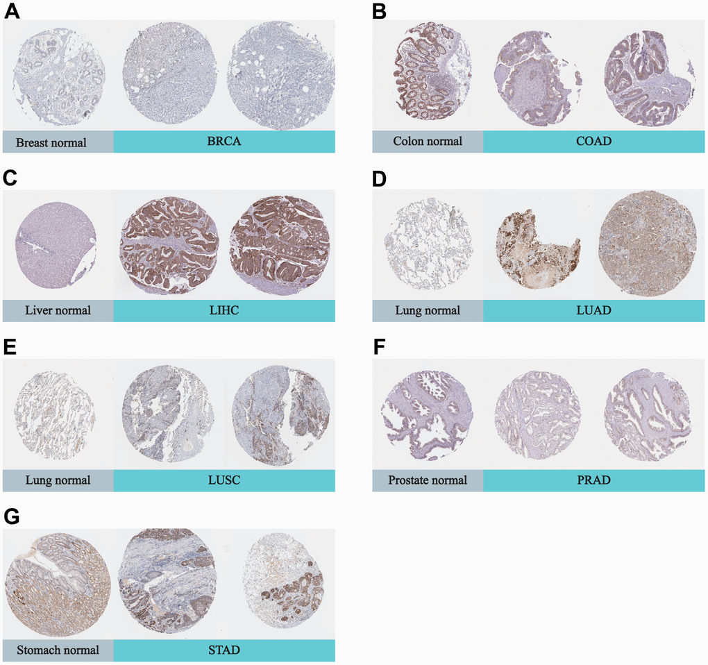 Representative IHC in various normal (left) and tumor (right) tissues. The protein expression of DLAT in (A) BRCA; (B) COAD; (C) LIHC; (D) LUAD; (E) LUSC; (F) PRAD; (G) STAD.