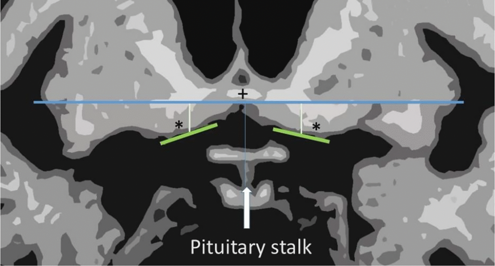 Schematic drawing of the measurement method. + - anterior commissure; * - nucleus basalis of Meynert; blue line - horizontal line under the anterior commissure; green line - line under nucleus basalis of Meynert; white orthogonal line- measured distances.