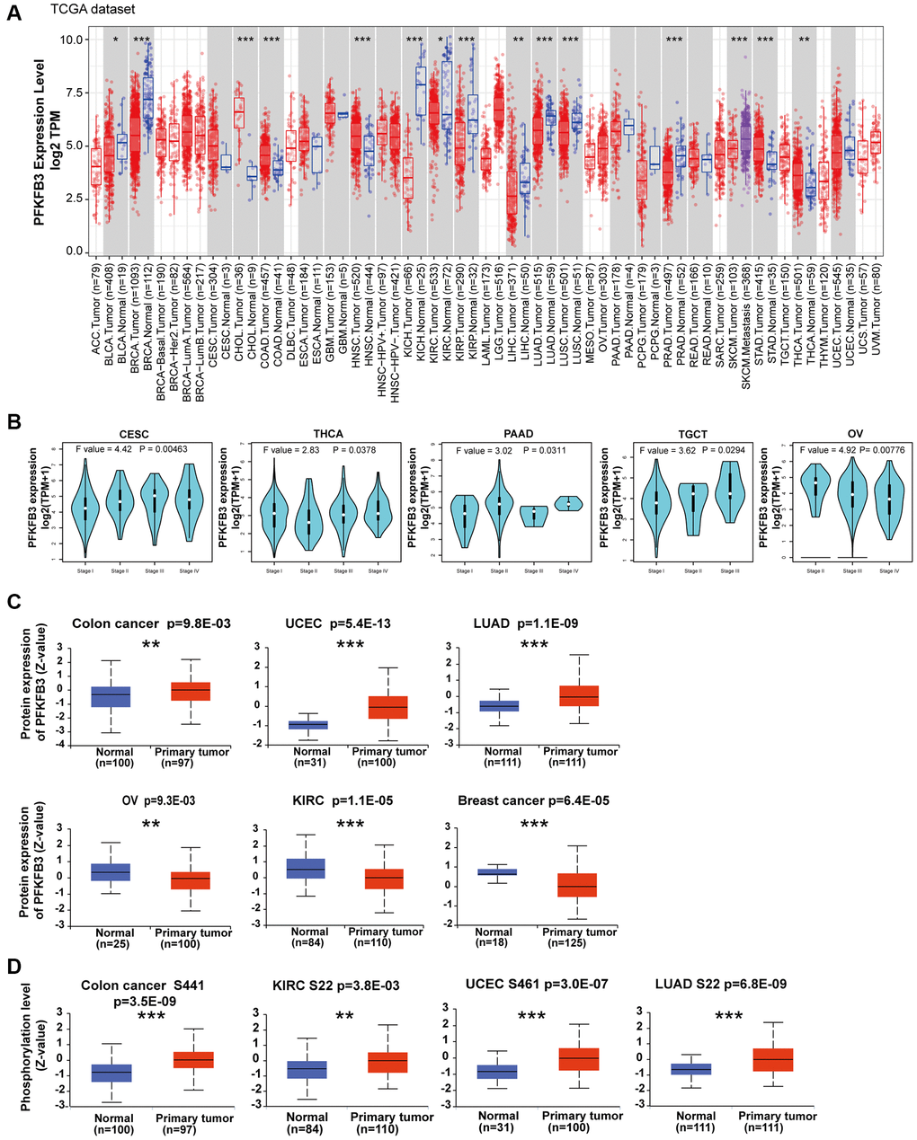 Expression level and phosphorylation of PFKFB3 in pan-cancer. (A) The expression status of the PFKFB3 gene in different cancers was analyzed via TIMER2. *P **P ***P B) The expression of the PFKFB3 gene was studied according to the pathological stage (stage I–IV) of the different TCGA cancers, including CESC, THCA, PAAD, TGCT, and OV. (C) We analyzed the expression level of PFKFB3 protein in tumor and non-tumor tissues of colon cancer, UCEC, LUAD, ovarian cancer, KIRC, and breast cancer by the CPTAC dataset. **P ***P D) We analyzed the phosphorylation level of PFKFB3 (S22, S461, and S441 sites) between primary tumor tissue and non-tumor tissues via the UALCAN. **P ***P 