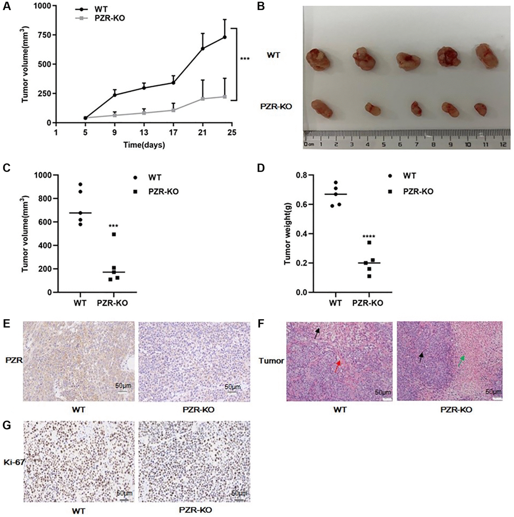 PZR knockout reduced tumor-forming ability of SPC-A1 cells in immunodeficient NYG mice. NYG mice (7-week male, 5 in each group) were subcutaneously engrafted with wild- type or PZR-KO SPC-A1 cells. (A) Tumor volumes were measured every four days from day 5. Tumor sizes are expressed as mean ± SD. (n = 5). ***P B–D) Size and weight of tumor tissues excised from NYG mice after 24 days of implantation. Error bars denote standard deviation (n = 5). ***P ****P E–G) Histochemical staining of paraffin-embedded tissue sections of tumors revealed that PZR-KO SPC-A1 cells displayed an absence of PZR expression in tumor cells (E), increased necrosis (green arrow) and lack of blood vessels (red arrows) (F), and reduced number of Ki-67-positive cells with PZR-KO SPC-A1 cells (G), (magnification, ×200).
