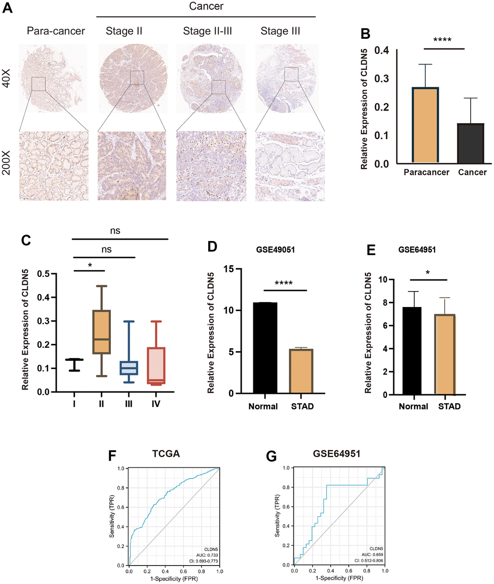 CLDN5 staining in gastric adenocarcinoma tissue microarrays using immunohistochemical methods. (A) CLDN5 is highly expressed in the para cancer and decreases with change in the pathological stage. (B) Relative expression of CLDN5 in 78 pairs of STAD and para-cancerous tissues (p C) Relationship between CLDN5 expression and clinical stage, CLDN5 was elevated in clinical stage II, consistent with TCGA results. (D) CLDN5 expression in GSE49051 datasets, CLDN5 expression was decreased in normal than STAD (p E–G) Validation of CLDN5 expression in GEO datasets and ROC curves analysis. (E) CLDN5 expression in GSE64951 datasets, CLDN5 expression was decreased in normal salivary than STAD salivary (p F) The TCGA training result. The AUC values were 0.733. (G) The GEO test sets results. The AUC values were 0.659.